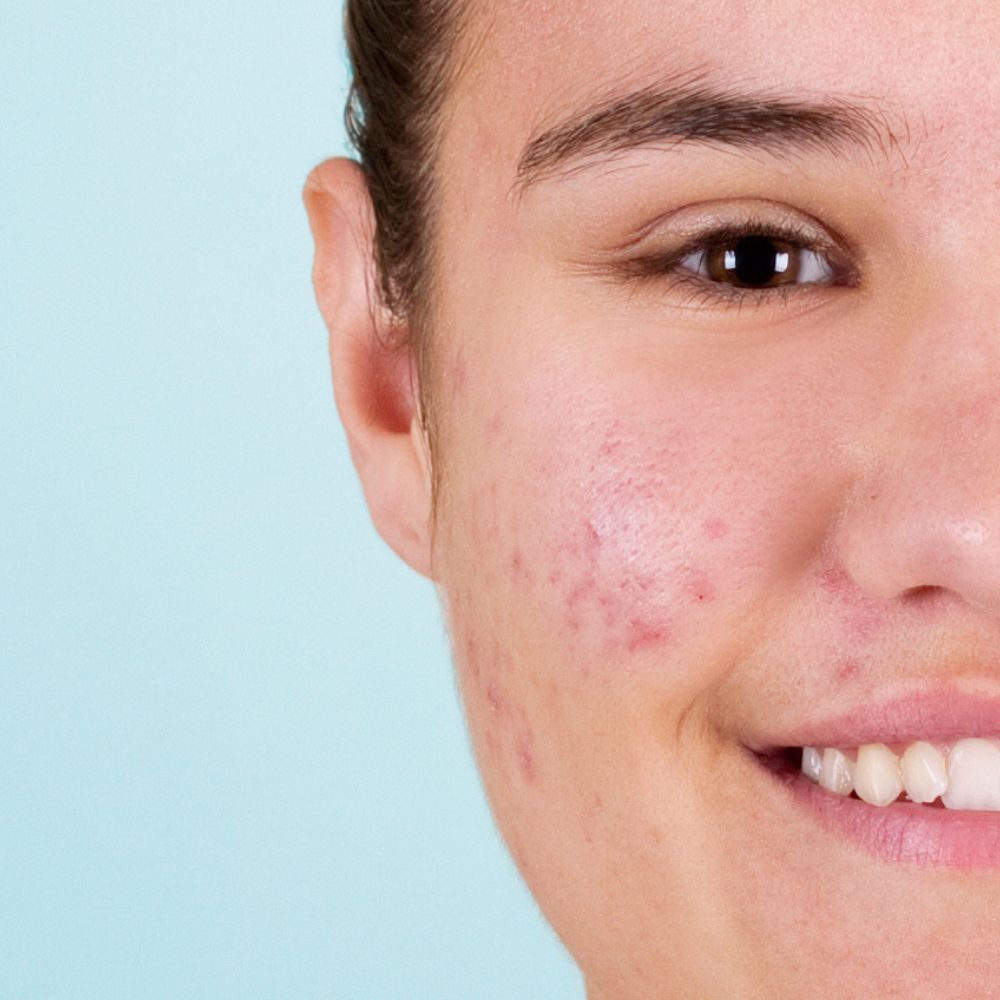 Une routine simple et efficace pour les peaux acnéiques des ados