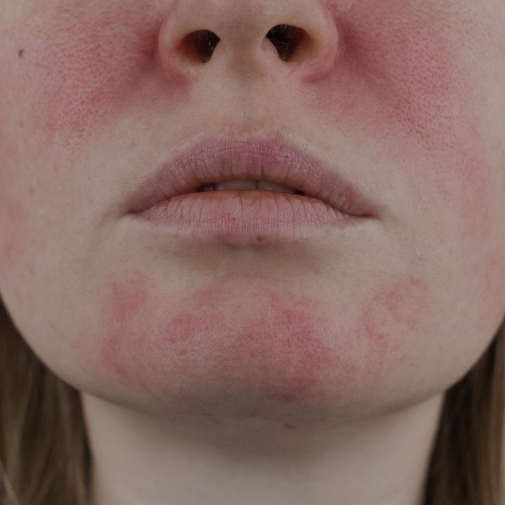Soin naturel pour la rosacée visage