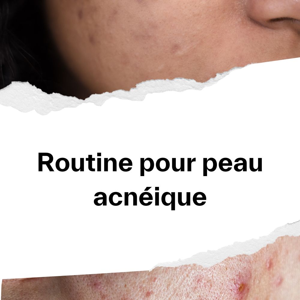 Routine pour peau acnéique